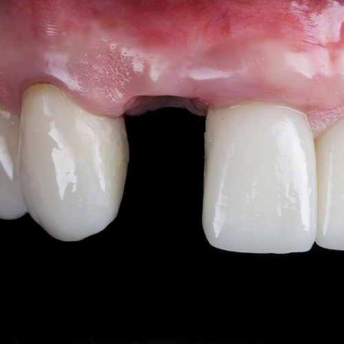 Dental Implants Victoria