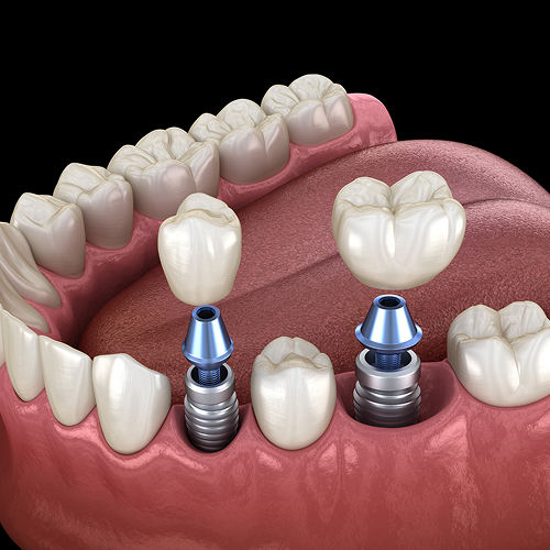 Dental Implants Victoria